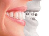 Dental Implants: A Permanent Solution For Missing Teeth