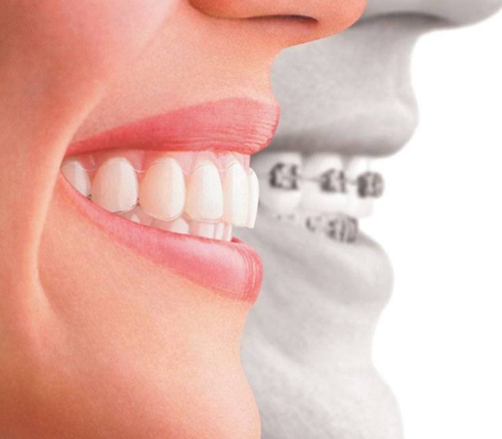 Dental Implants: A Permanent Solution For Missing Teeth
